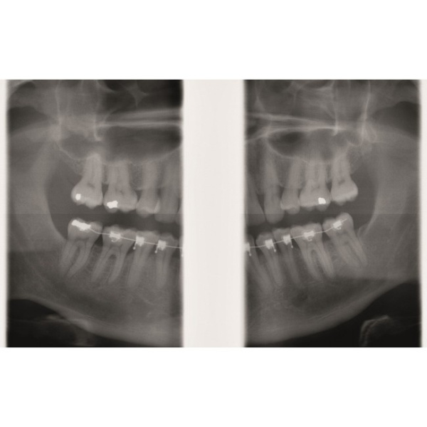 KaVo GENDEX GXDP-300 - цифровая панорамная рентгенодиагностическая система