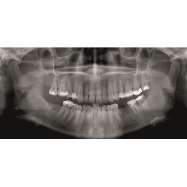 KaVo GENDEX GXDP-300 - цифровая панорамная рентгенодиагностическая система