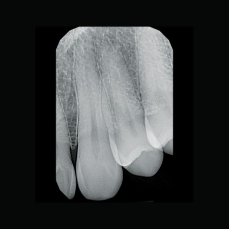 KaVo Gendex GXS-700 - система компьютерной радиовизиографии (сенсор №1)